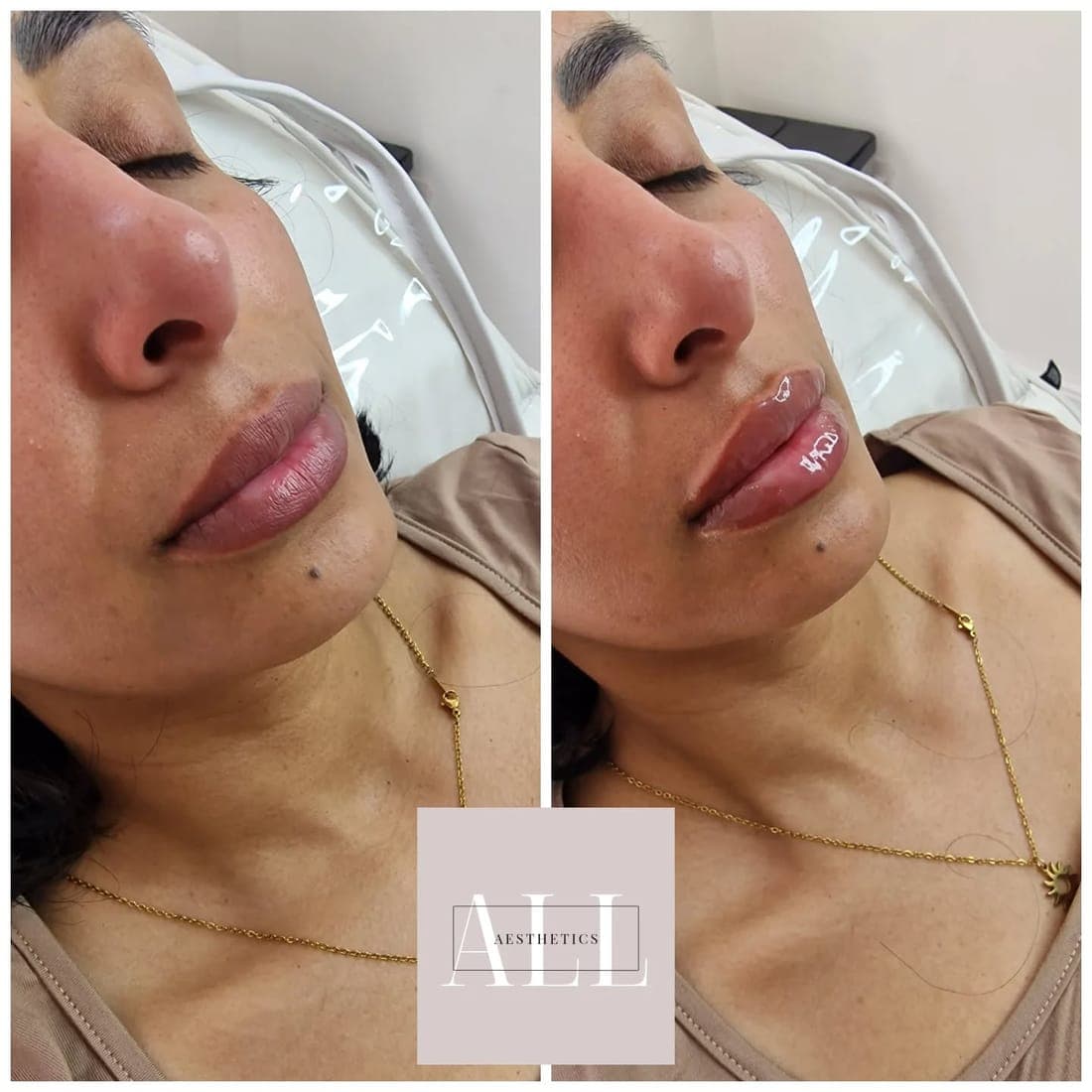 Lips before and after, side by side, client lying back