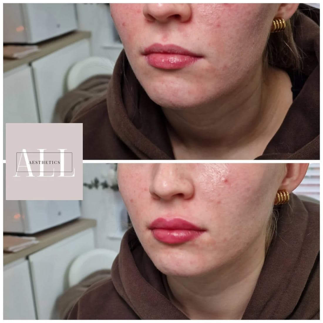 Lips front view, before above and after below